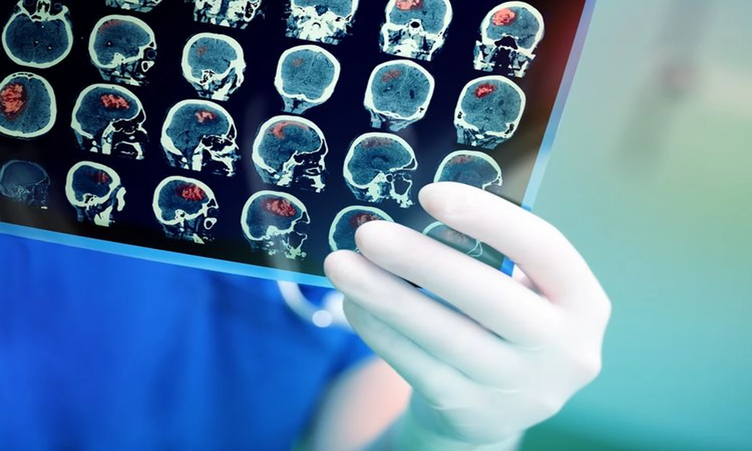 Mengetahui Faktor Risiko Tumor Otak yang Sering Diabaikan