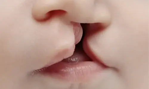 bibir sumbing
